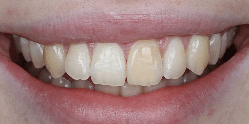 Entdecken Sie mit Aura One, was professionelles Bleaching leisten kann – Courtesy of Dr. Aria Köppen