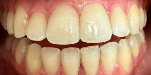 Entdecken Sie mit Aura One, was professionelles Bleaching leisten kann – Ilkan Apaydin B.Sc. • Aura